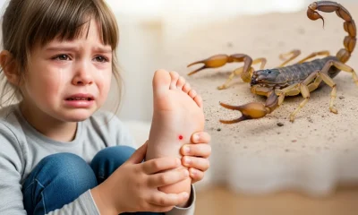 How to Treat Scorpion Sting on a Child